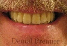 implant-dentar-fast&fixed-aspectul-lucrarii-definitive